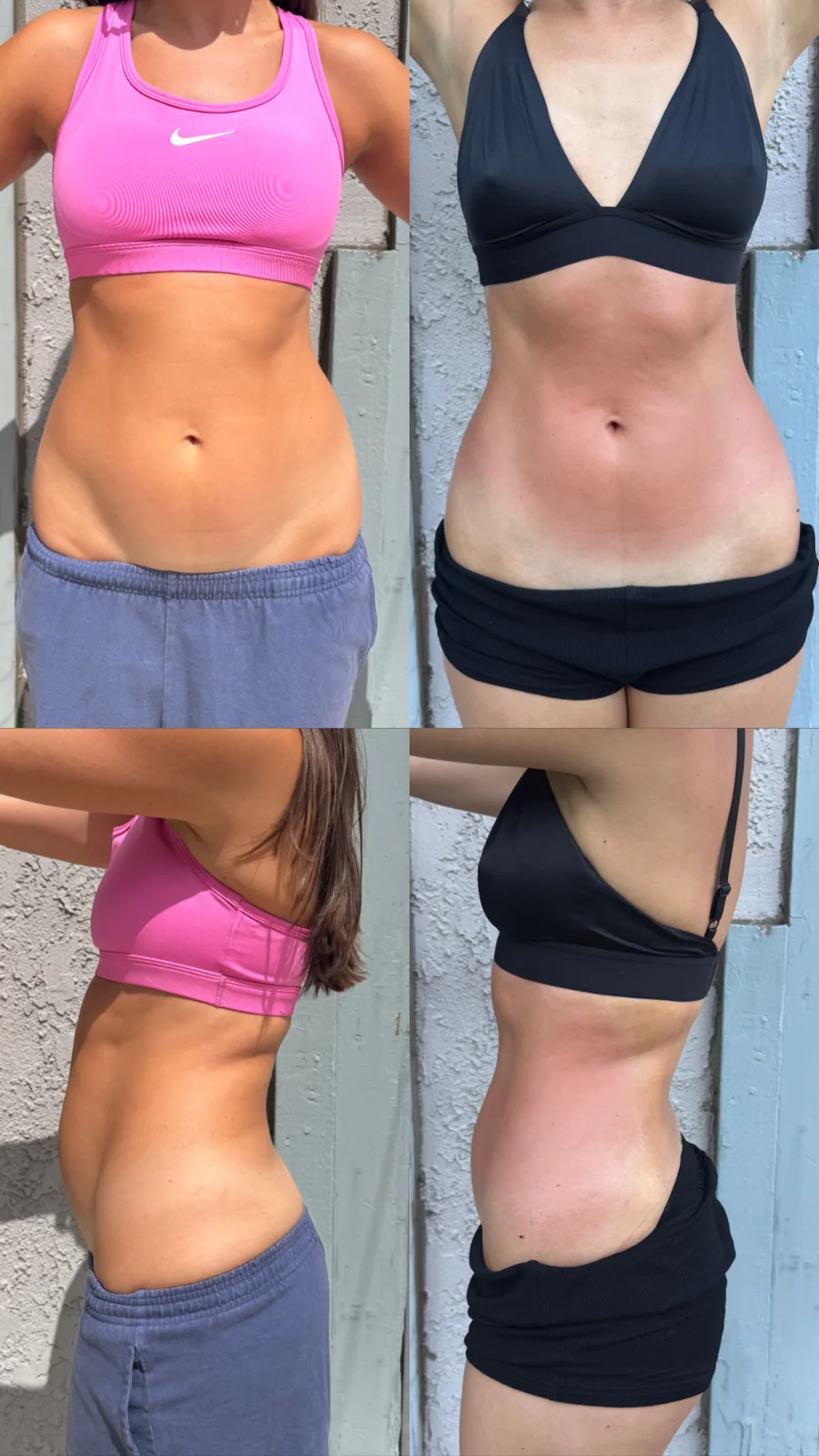 Abdomen + waist contour, front and side: original before and after torso comparisons